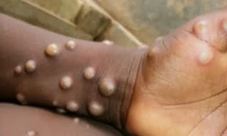 Salud Pública recomienda mantener medidas de higiene