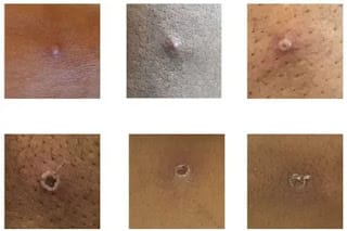 4 claves para entender por qué la viruela del mono ya es una emergencia internacional 10 4 claves para entender por qué la viruela del mono ya es una emergencia internacional