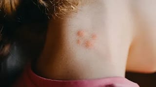 Más del 30% de la población mundial sufre algún tipo de alergia