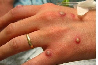 Conoce la diferencia entre varicela, rubéola, sarampión y viruela