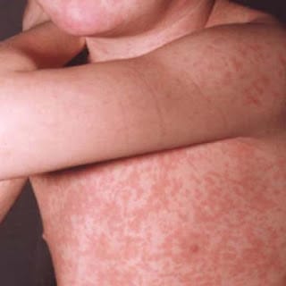 Conoce la diferencia entre varicela, rubéola, sarampión y viruela