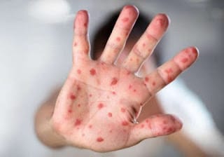Alerta Epidemiológica: Sarampión en América - Medidas y Prevención 5