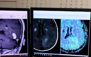 Una nueva herramienta basada en IA permitirá mejorar el diagnóstico de tumores cerebrales 5